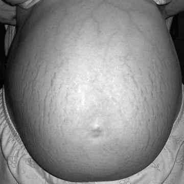 Rozstępy ciążowe u kobiety 2 tygodnie przed porodem, Źródło: pl.wikipedia.org