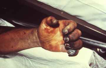 Hand necrosis casued by plague, źródło: wikipedia
