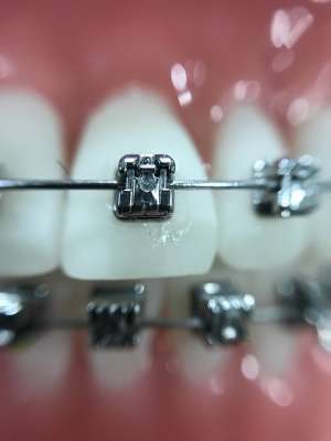 Aparat ortodontyczny - zdjęcie partnera